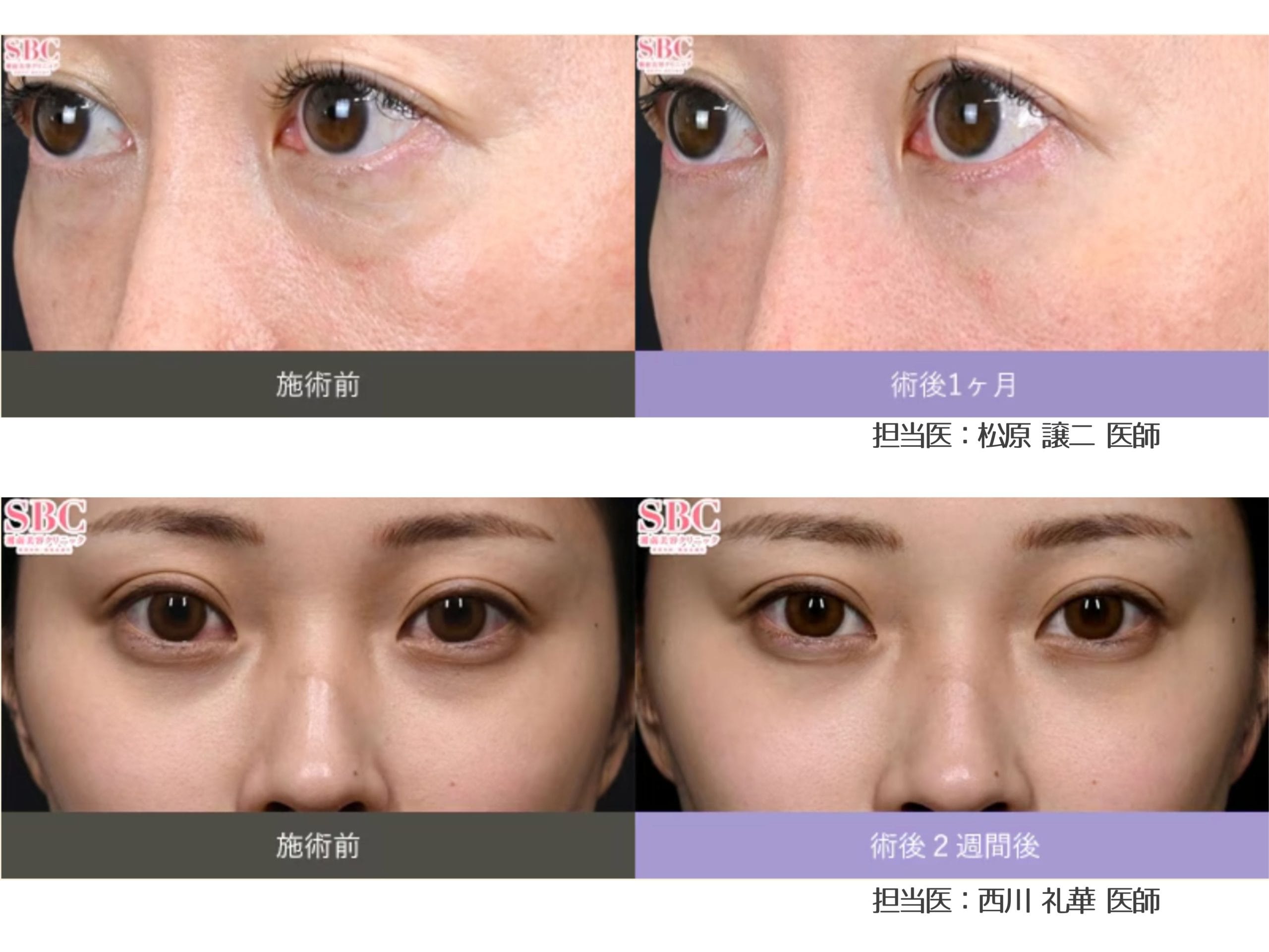 目の下のクマ（黒クマ・影クマ）