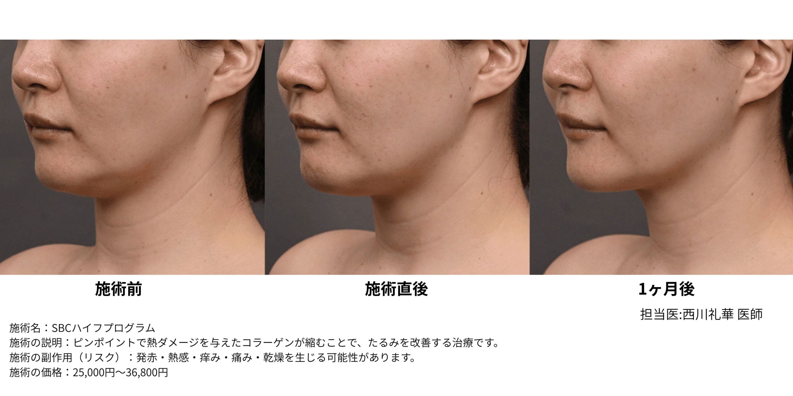 SBCハイフプログラム