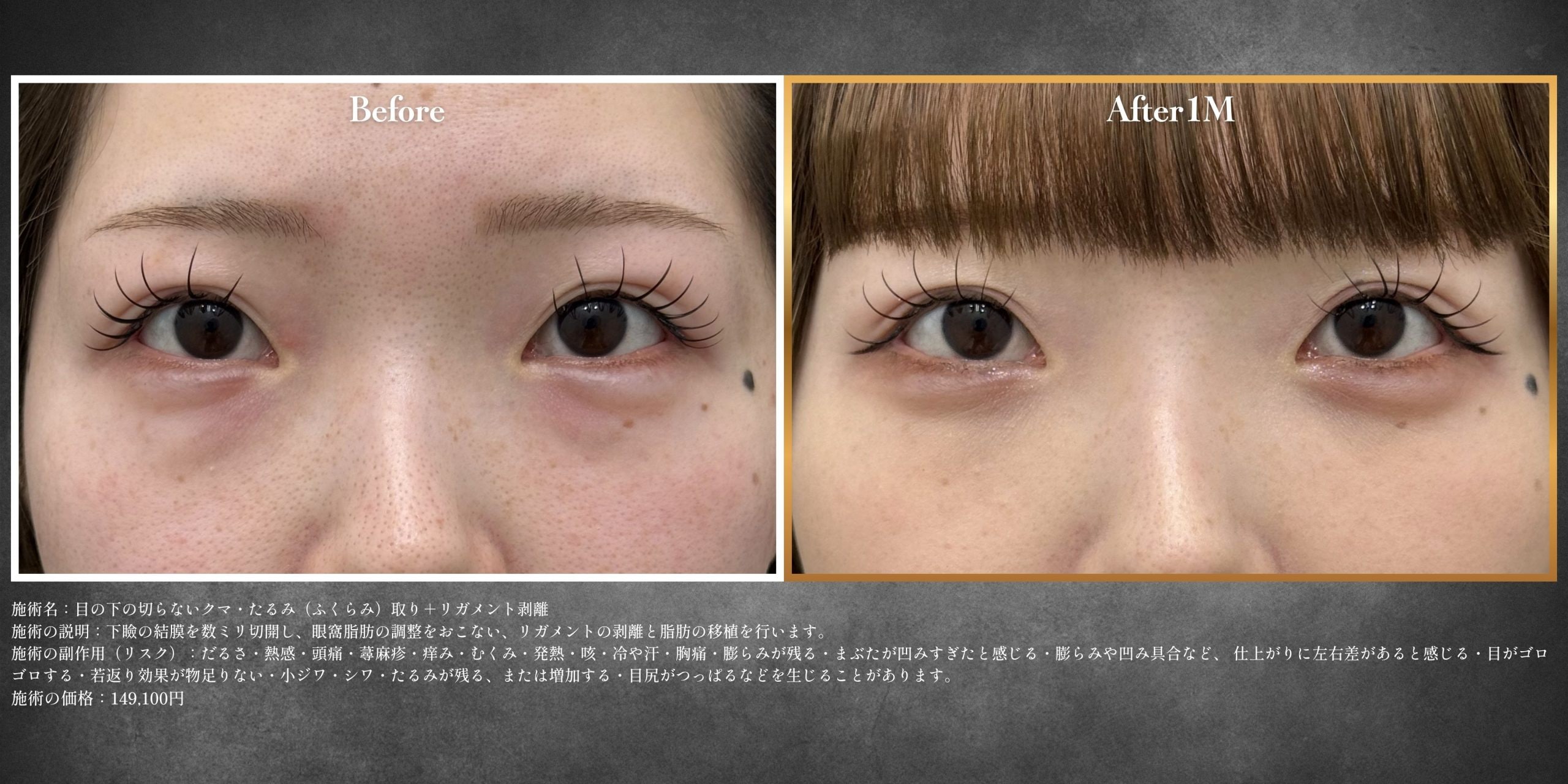 case3 目の下の切らないクマ・たるみ（ふくらみ）取り+リガメント剥離