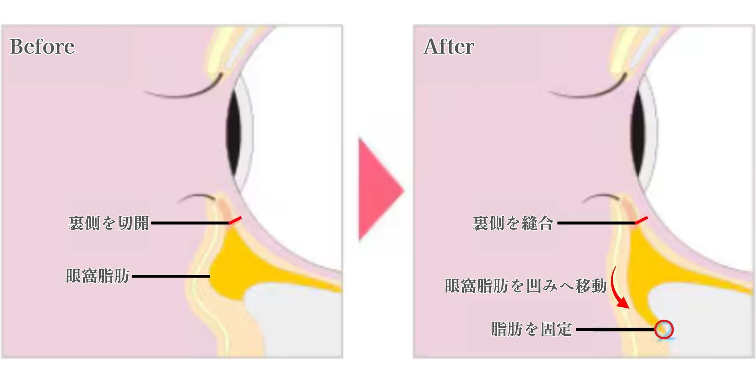 目の下のふくらみとくぼみに着目する「裏ハムラ法」