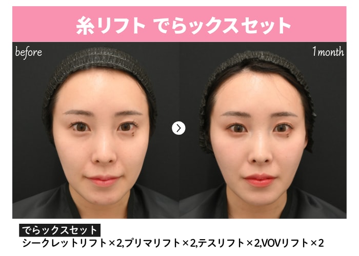 糸リフト症例