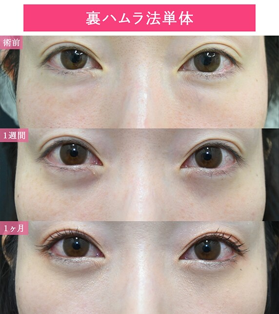 裏ハムラ法単体のダウンタイム