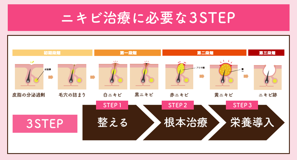 ニキビ治療に必要不可欠な３STEP