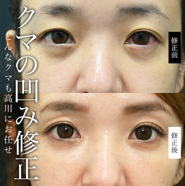 目の下が窪む理由とは？