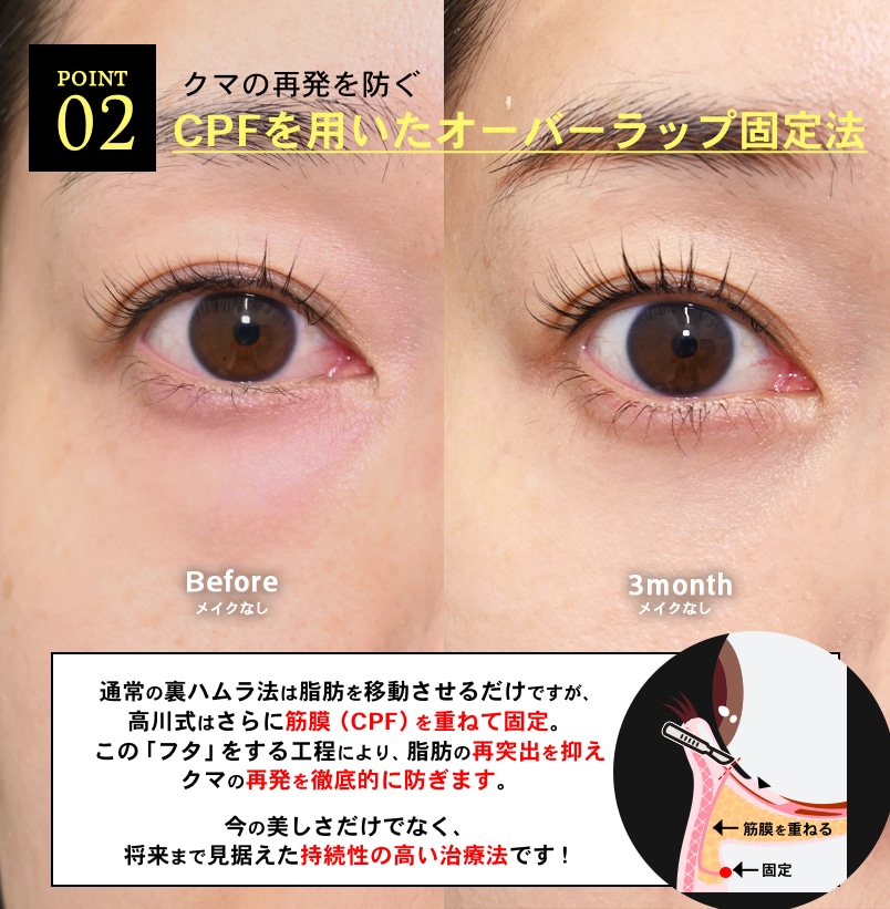 再発予防を極めた高川式ハムラ