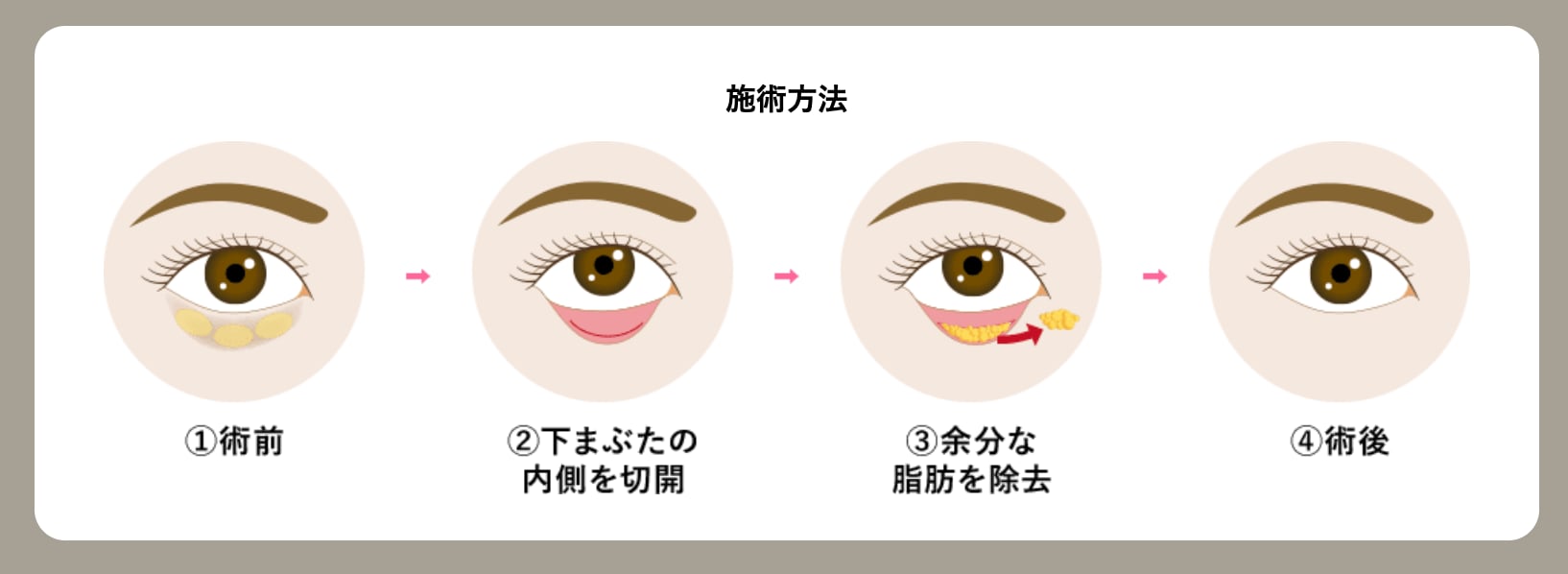 クマ取りとは？