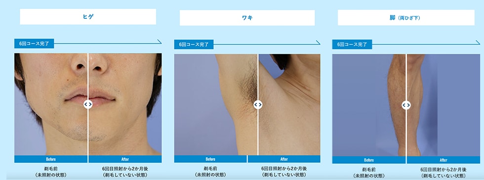 男性の頑固な毛でもしっかり脱毛