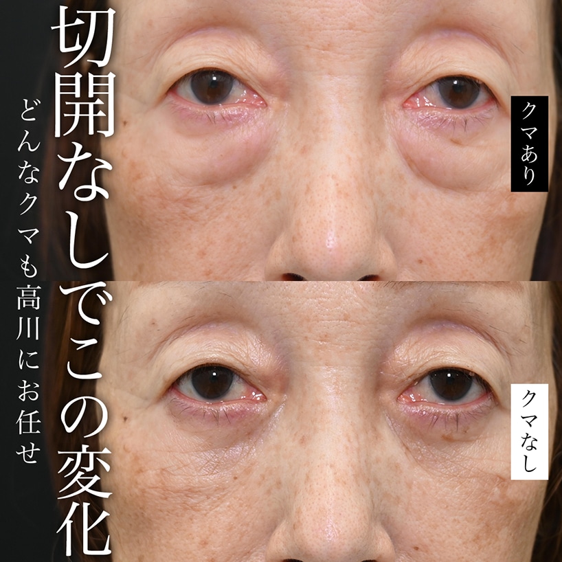 切開レベルでも切らずに治療