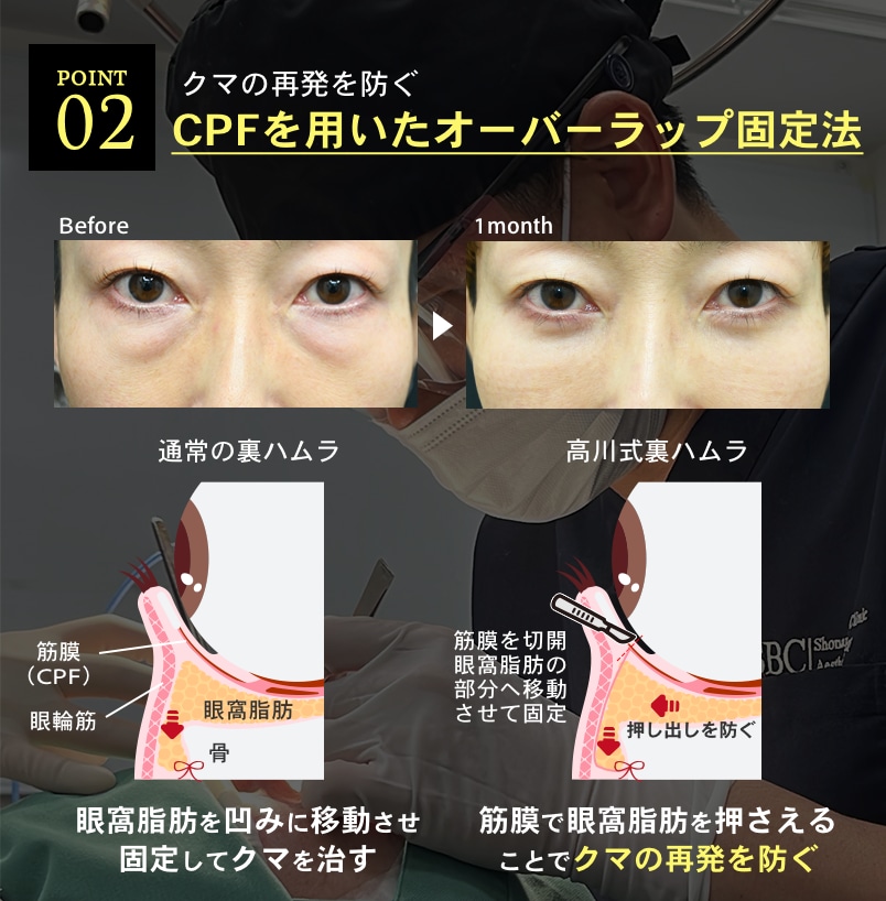 【再発を防ぐ】CPFを用いたオーバーラップ固定法