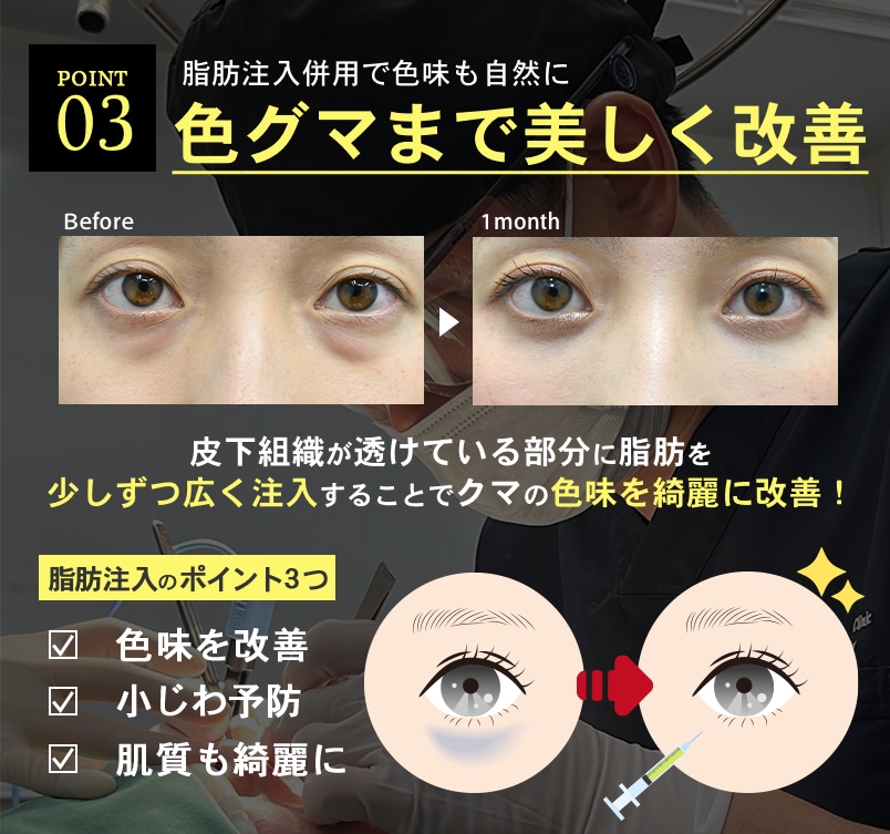 【色グマまで美しく】脂肪注入併用で色味も自然に