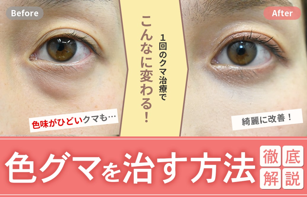 色グマは綺麗に治らない？“その原因“と“正しい治し方”を専門医が解説！