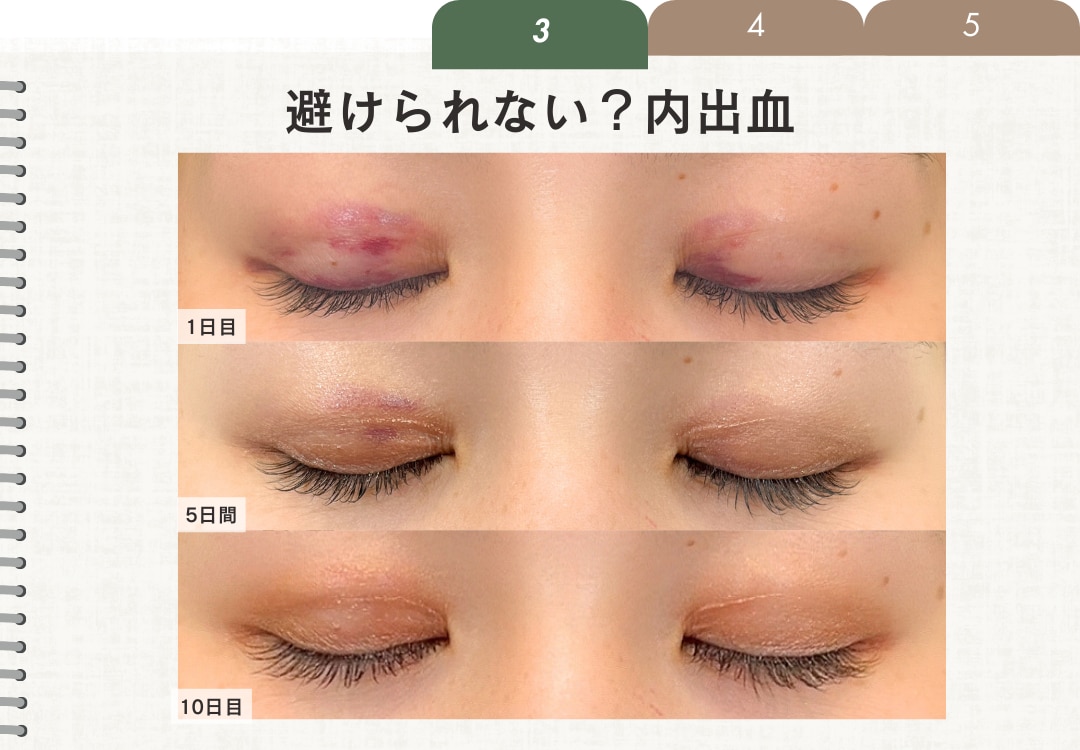 避けられない「内出血」
