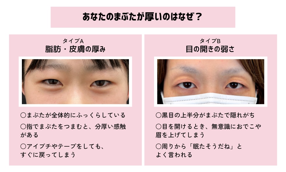 あなたの重いまぶたタイプ別セルフチェック