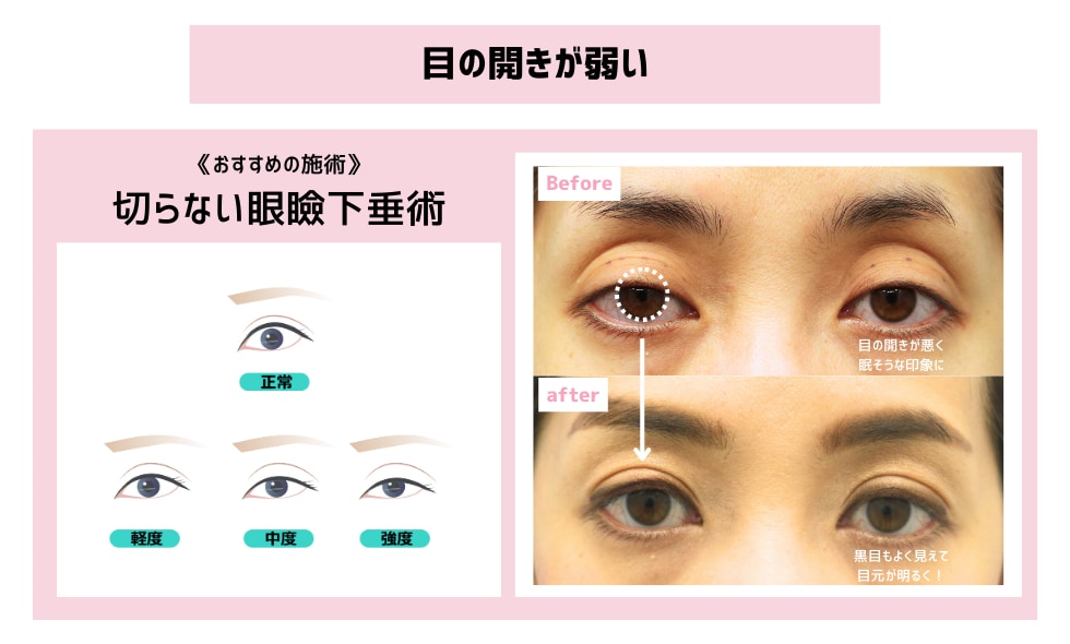 目の開きが弱いタイプの方へ
