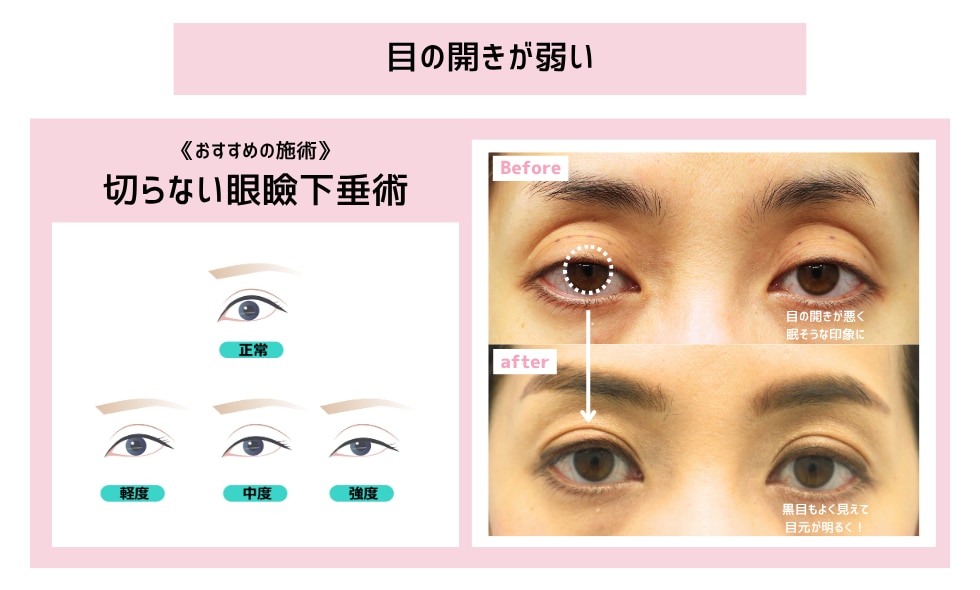 目の開きが弱いタイプの方へ