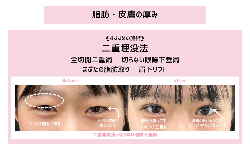 脂肪・皮膚が厚いタイプの方へ