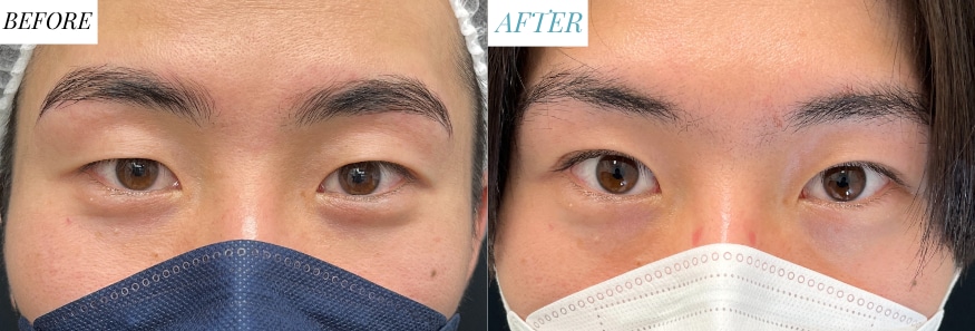 症例1：奥二重から自然な末広型二重へ、より知的なモテ男子に