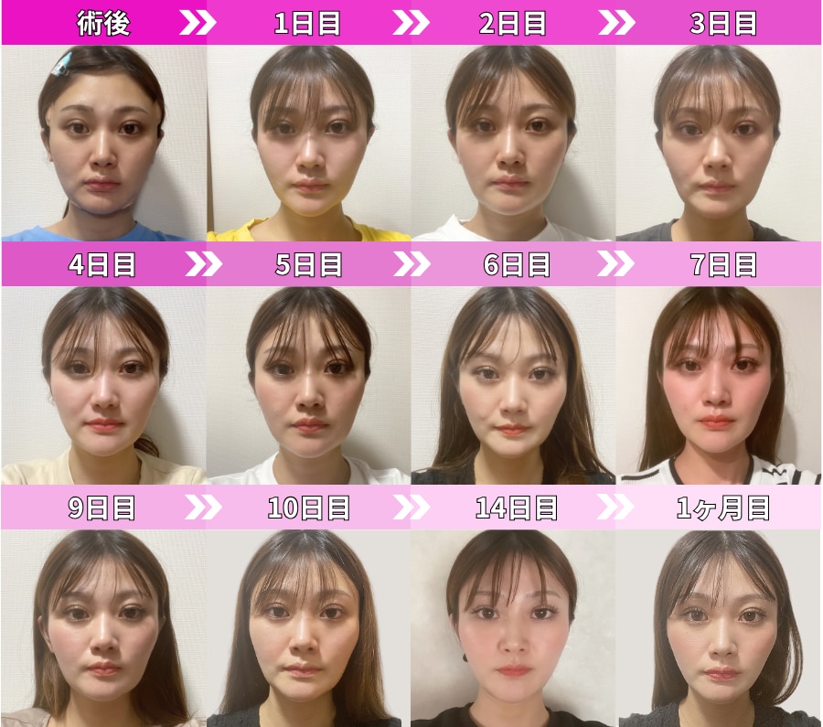 術後〜1ヶ月