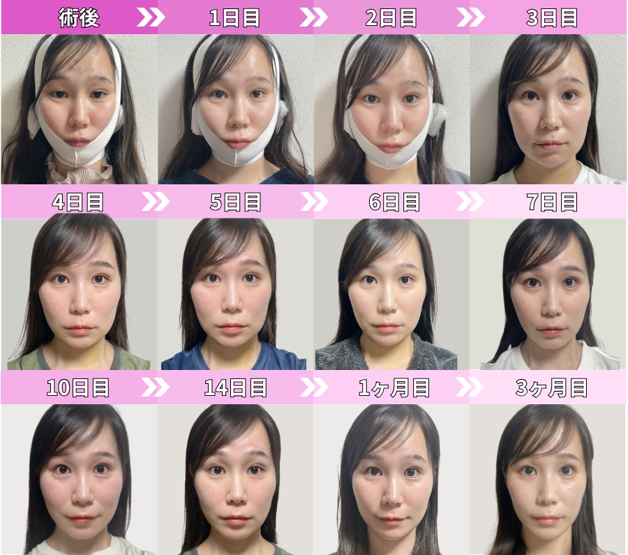 術後〜3ヶ月
