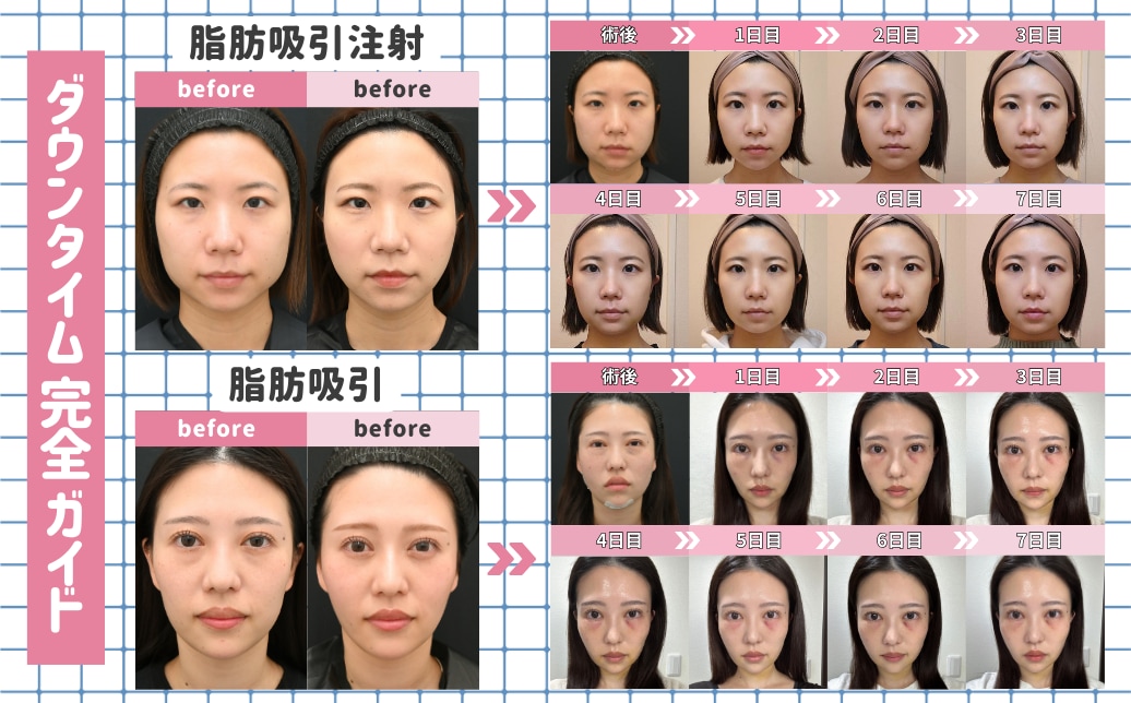 脂肪吸引注射・脂肪吸引のダウンタイム完全ガイド:名古屋のベテラン医師が教えます