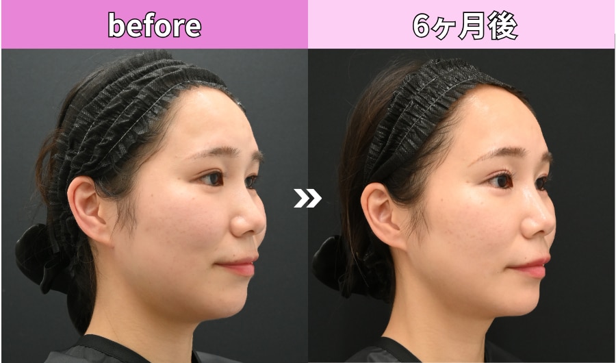 before・after