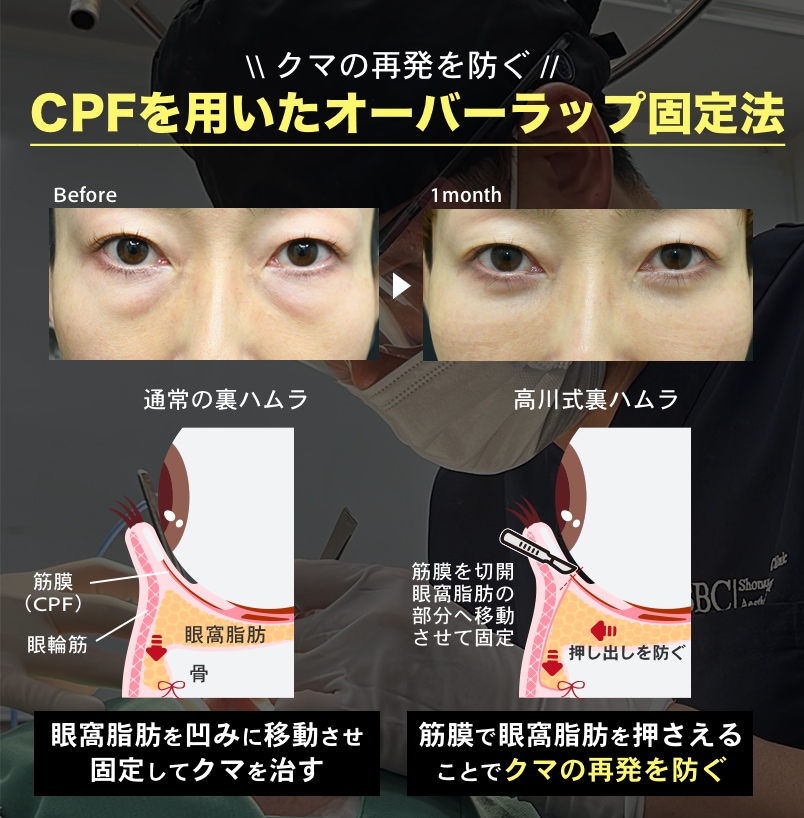 再発予防を極めた高川式ハムラ