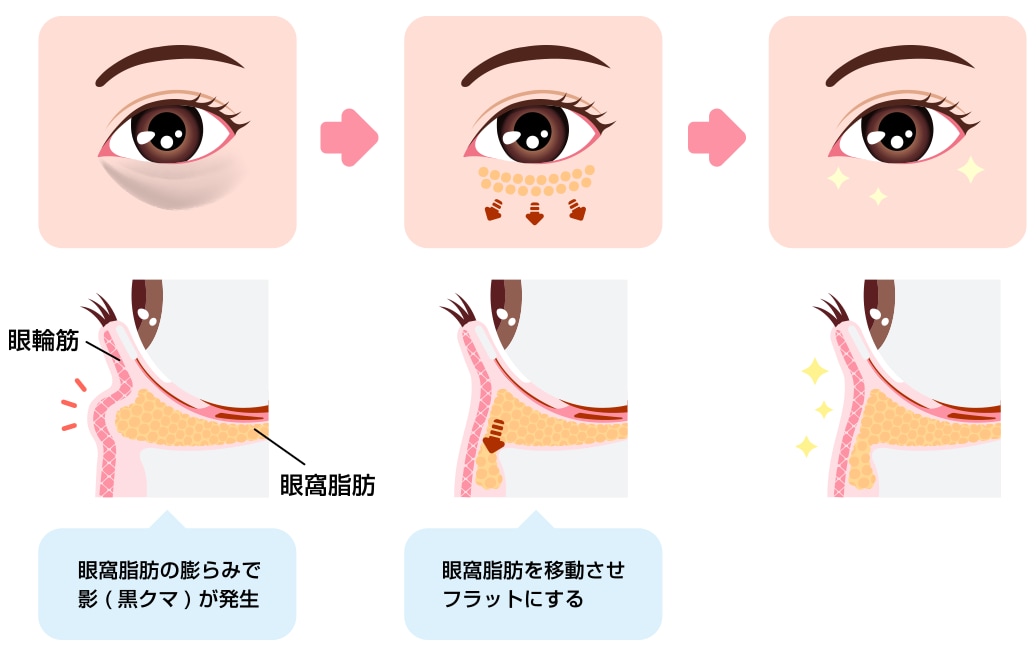 裏ハムラ法の手術内容