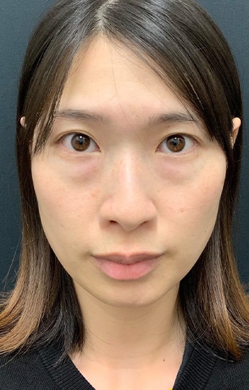 裏ハムラ法