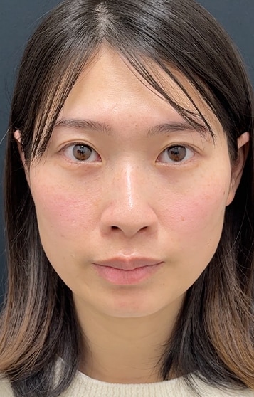 裏ハムラ法
