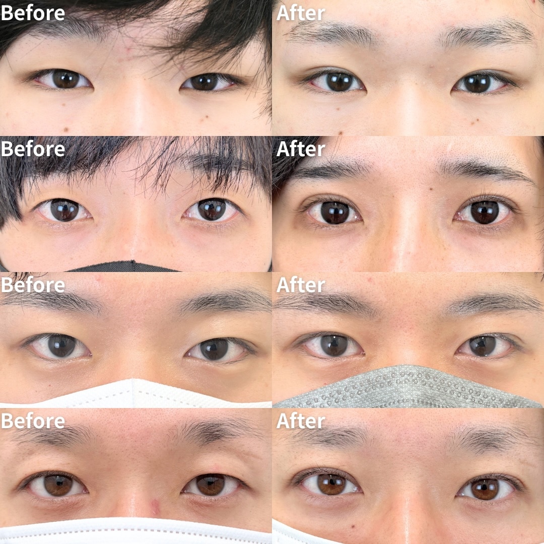 男性の二重整形 症例紹介