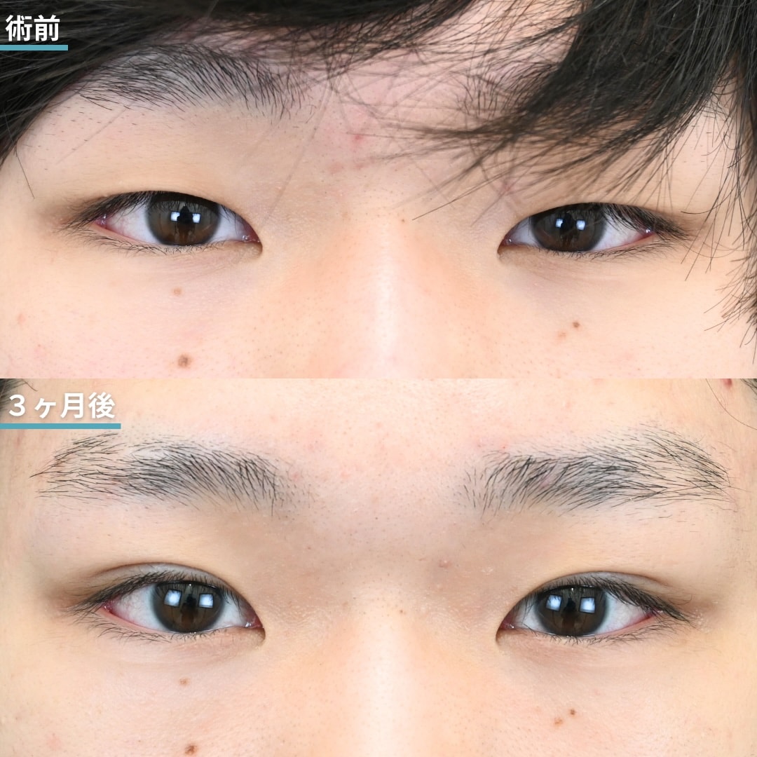 【10代・大学生】目の開きが良くなって別人級垢抜け！