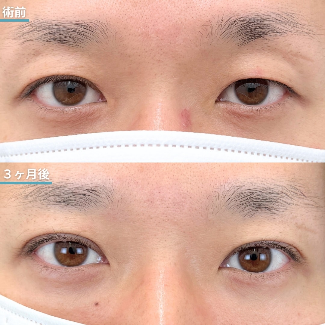 【30代・会社員】印象は大きく変えず、左右差を整えて垢抜けを実現