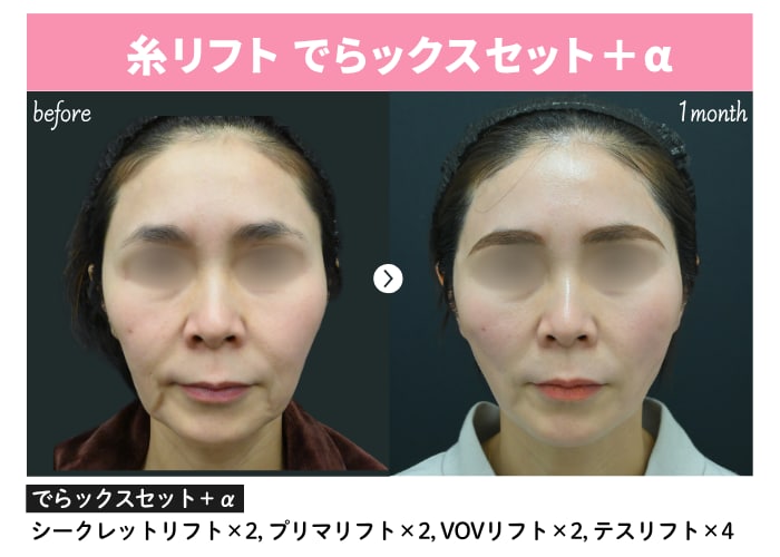 糸リフト症例【50代】
