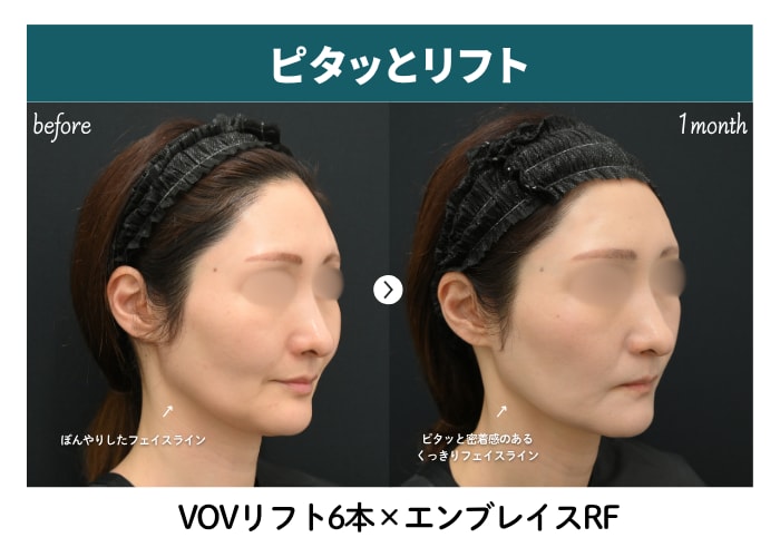Before→After