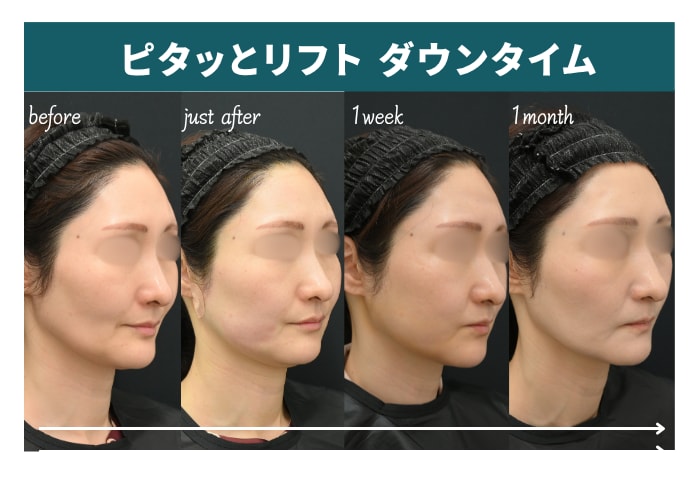 ピタッとリフトのダウンタイム