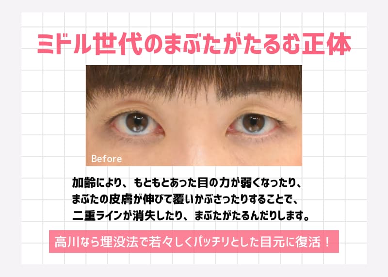 切らない二重埋没法