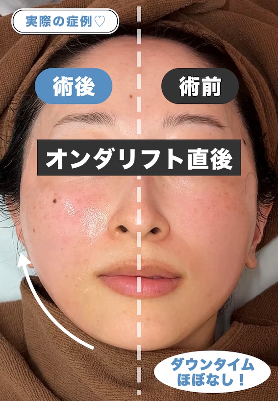 オンダリフト施術直後の写真
