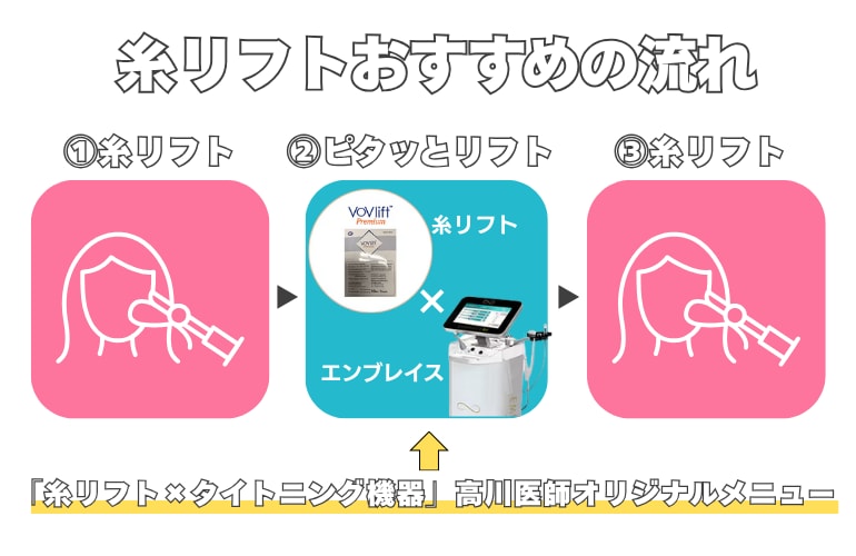 糸リフト→ピタッとリフト→糸リフト