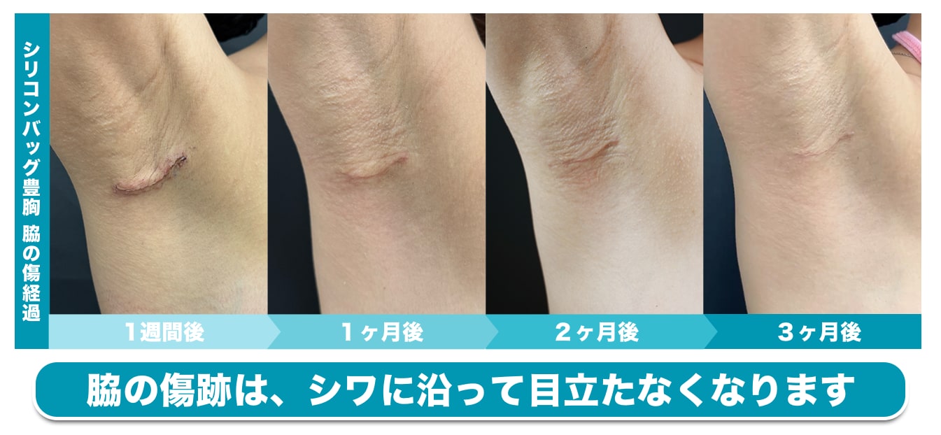 ダウンタイム【③傷跡】
