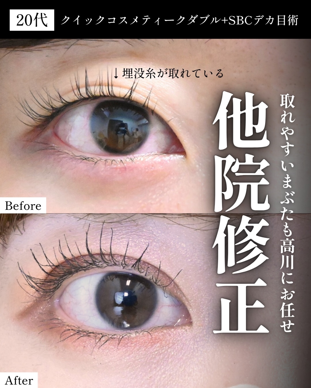 ①二重のラインが取れた・薄くなった