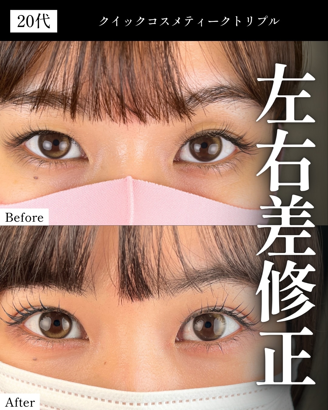 ②二重の幅が不自然(広すぎる・狭すぎる・左右差)