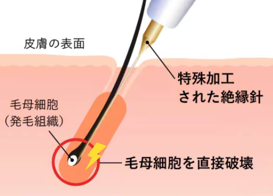 ニードル脱毛って何?