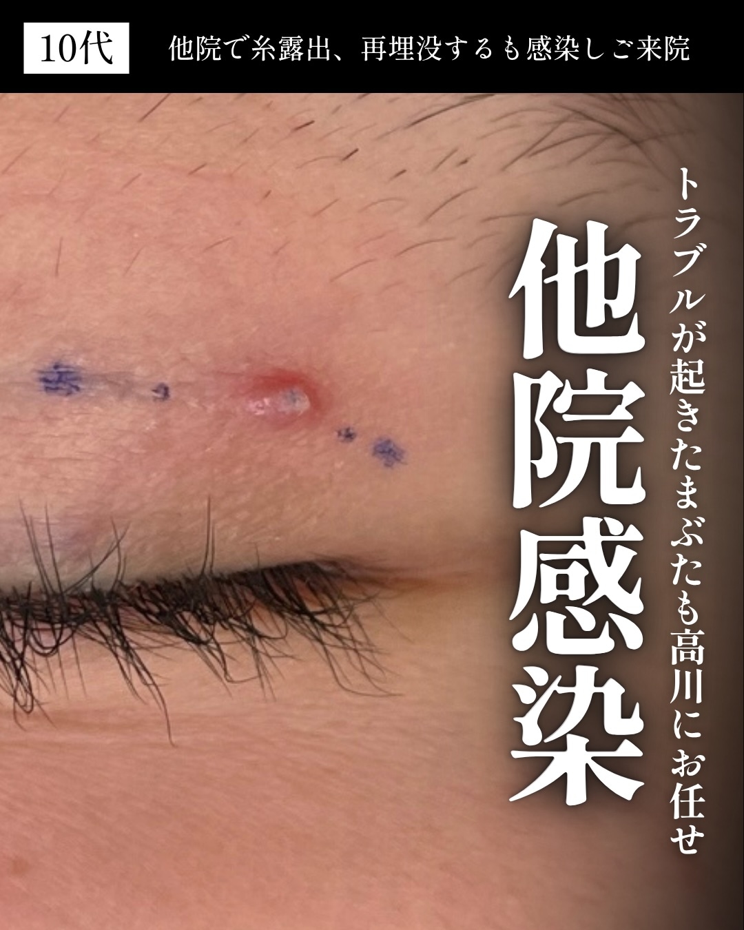 ④糸のふくらみ・ボコつきが目立つ