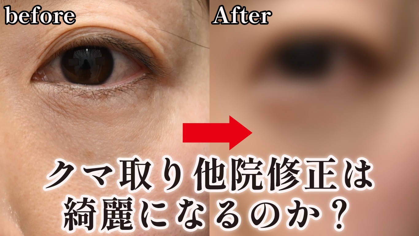 クマ取りの他院修正が増えています!失敗例や治療法を解説【クマ取り名医中野医師監修】
