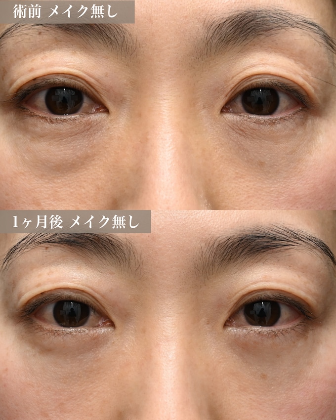 ①効果が実感できなかった（ふくらみが残る・左右差がある）