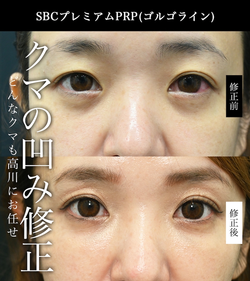 ②目の下が凹んでしまった