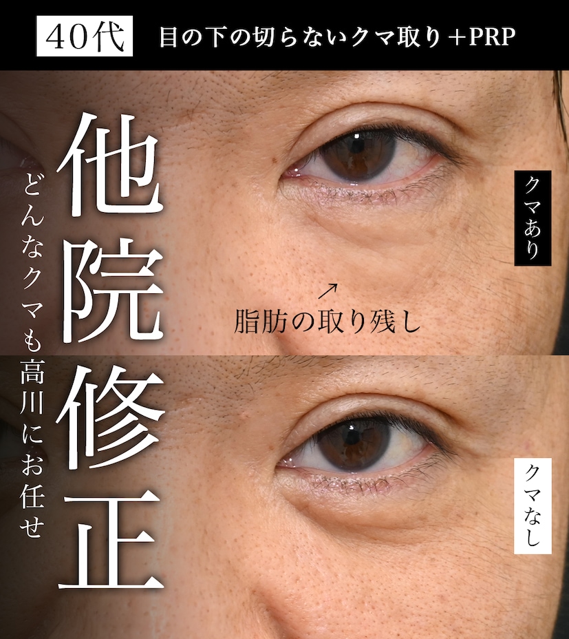 ①効果が実感できなかった(ふくらみが残る・左右差がある)