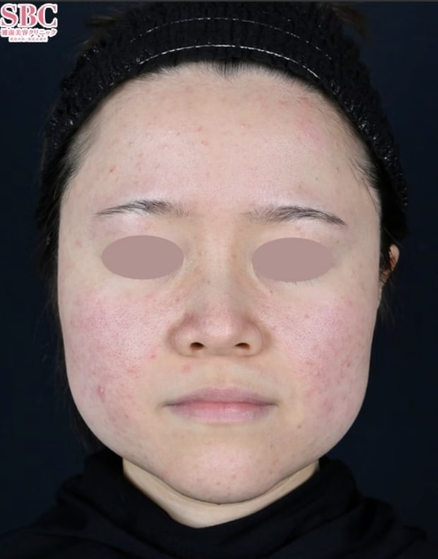 ボトックス注射のご予約