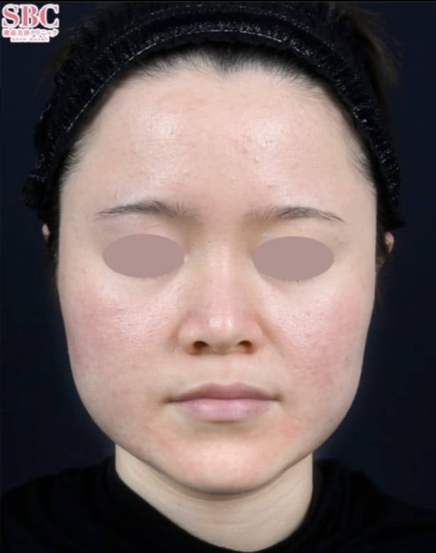 ボトックス注射のご予約