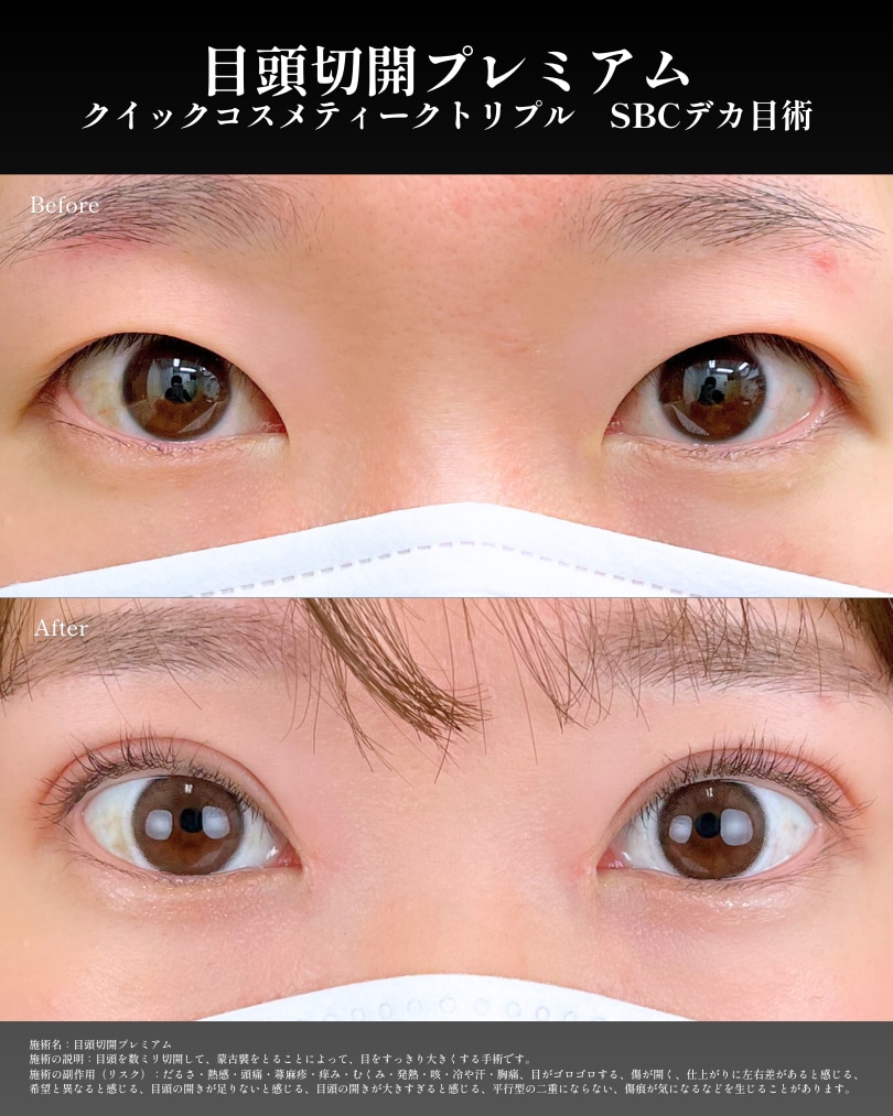 離れ目改善・平行二重